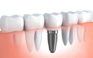 Dental Implants Dental Implants